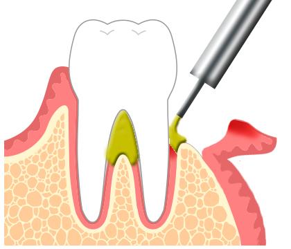 歯周再生療法
