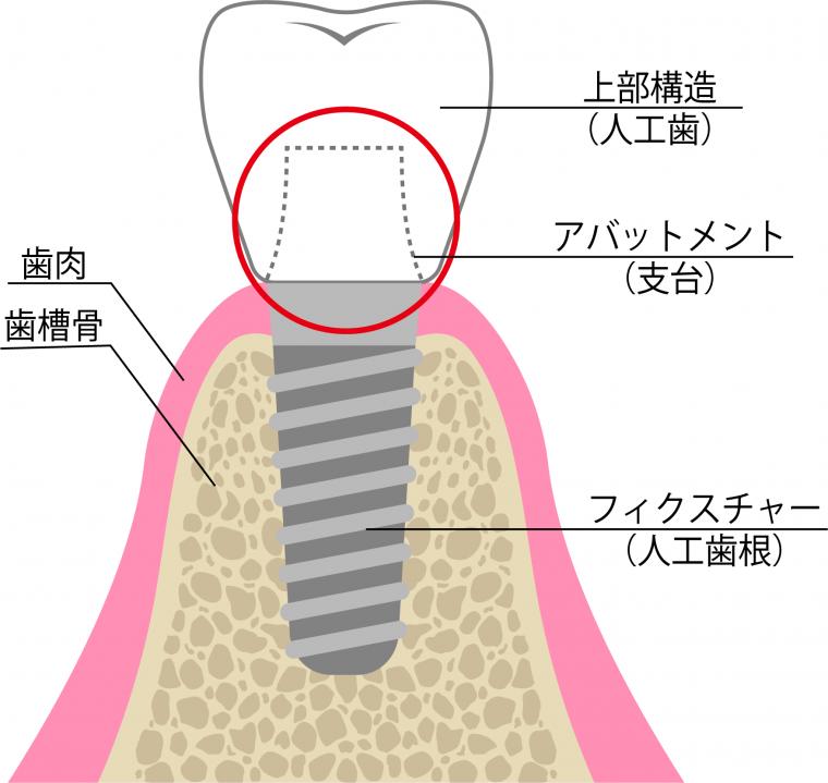 アバットメントについて