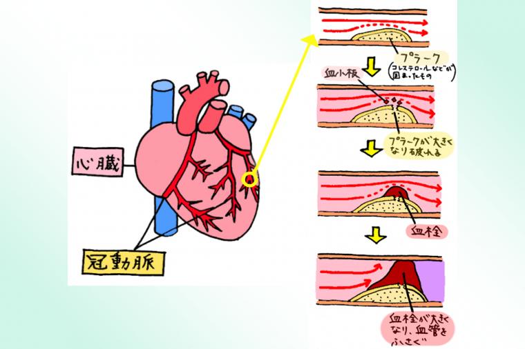 歯周病が招く…本当に怖い合併症