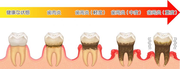 歯周病について