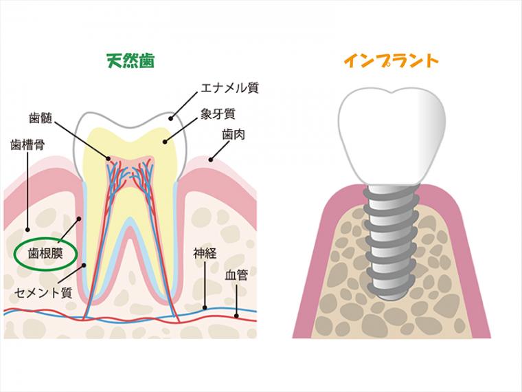 インプラントと天然歯の違いについて