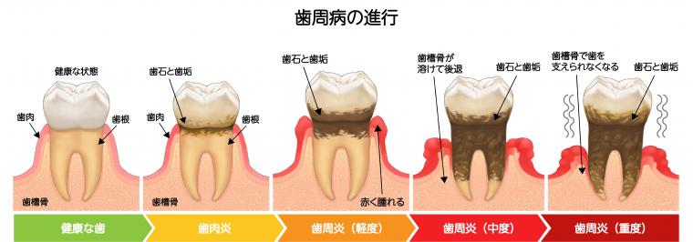 歯周病の「歯肉炎」と「歯周炎」の違いについて