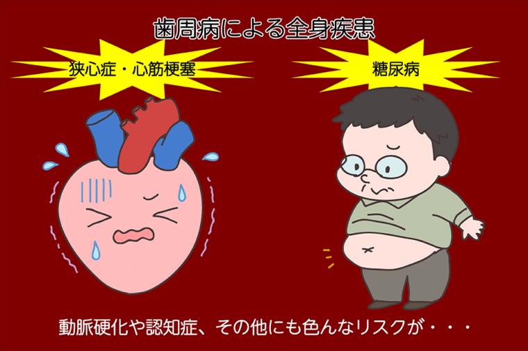 歯周病の「歯肉炎」と「歯周炎」の違いについて