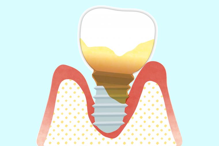 インプラントのメンテナンスって？