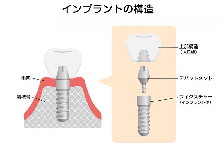 インプラントのメンテナンスって？