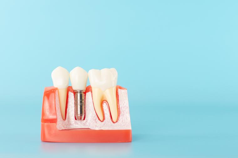 インプラント治療は大手歯科医院でやった方が良い？