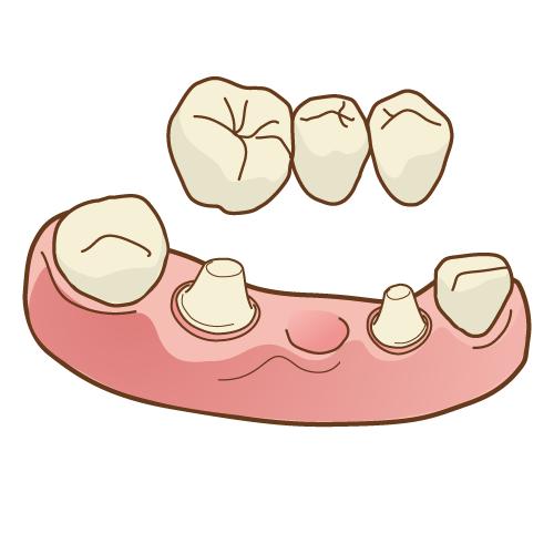 歯を失ったときの選択肢〜ブリッジ〜