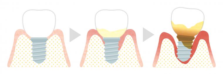 インプラント周囲炎について