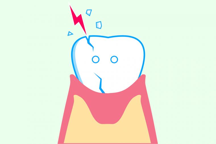 鏡で見ると歯にひび割れが…。原因と治療法とは！