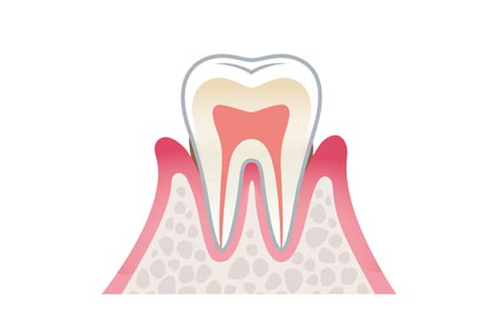 軽度の歯周病