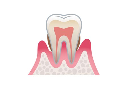 中程度の歯周病