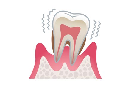 重度の歯周病