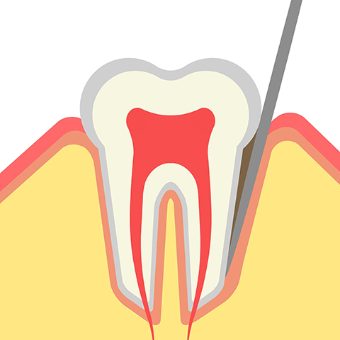 歯周ポケットについて