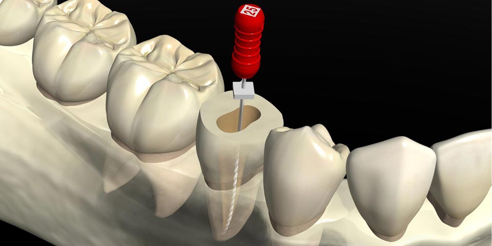 外科的歯内治療とは